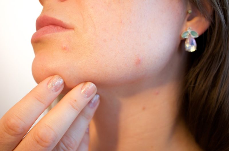 Comment éviter l'apparition de boutons d'acné ?
